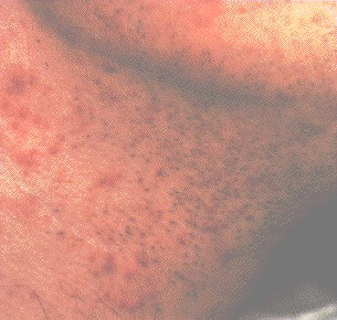 What is Folliculitis