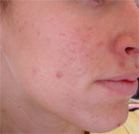 AcneStar Before and After Images