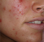 AcneStar Before and After Images