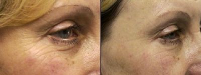 Before and After Images