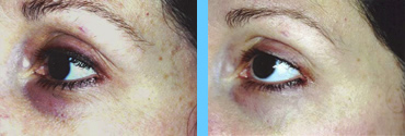 Medik8 Dark Circles before and After Images
