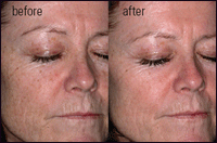 Even Tones before and after picture