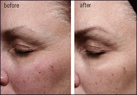 Idebenone moisturiser before and after picture