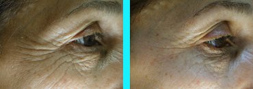 Pretox eyelift Before and After Images