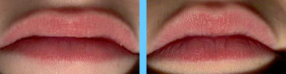 Pretox Pout Before and After Images