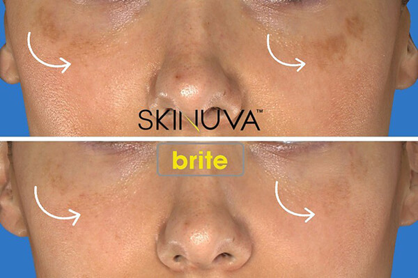 skinuva brite