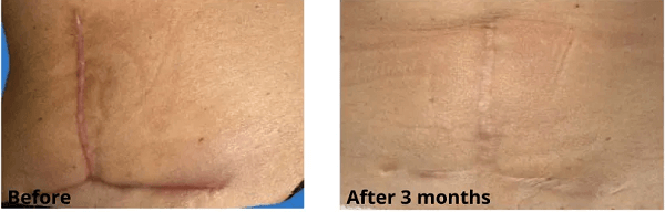 skinuva scar