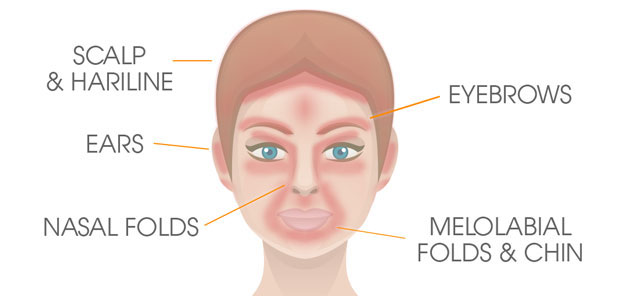 Seborrhoeic Dermatitis