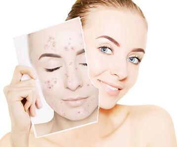 Acne scars: What's the best treatments? 