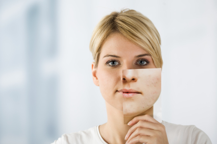 Acne treatment Tips