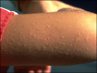 FAQ's - I have little white bumps on the back of my upper arms