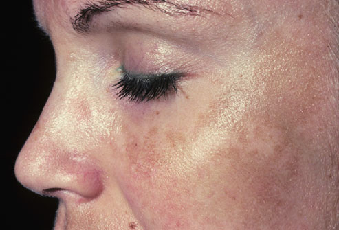 Hyperpigmentation Treatment Tips