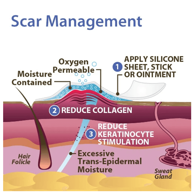 Silicone scar sheets top