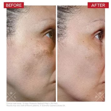Dr LEVY Radical3 Reboot Pro Peel