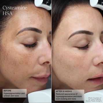 Sente Pigment & Tone Correcting Mask - Cysteamine + HSA  - Expiry Date 30th September 2026 (non-refundable)