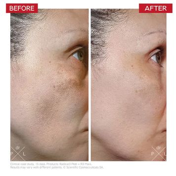 Dr LEVY Radical3 Reboot Pro Peel