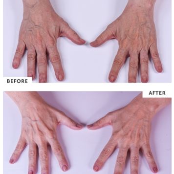 SilcSkin Hand & Body Treatment 