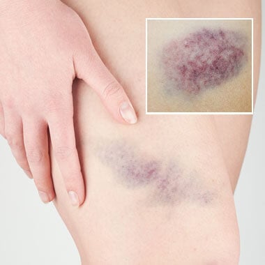 Bruise Relief Treatments