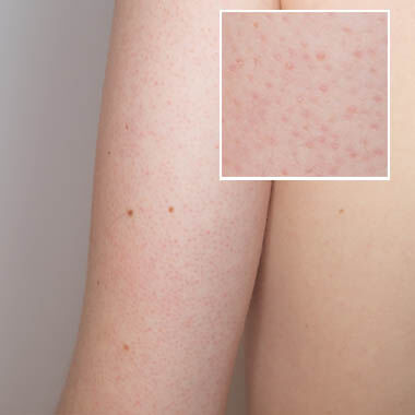 pilaris keratosis concern