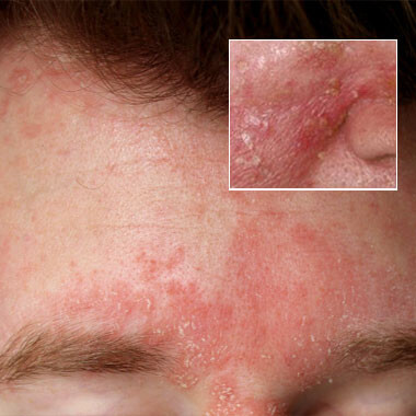 Seborrhoeic Dermatitis 