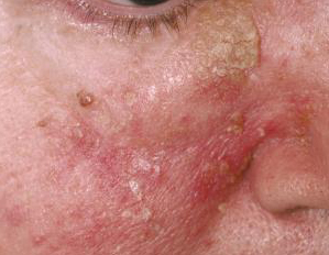 Seborrhoeic dermatitis