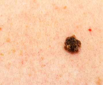 Skin Cancer Awareness Month - Types of Skin Cancer