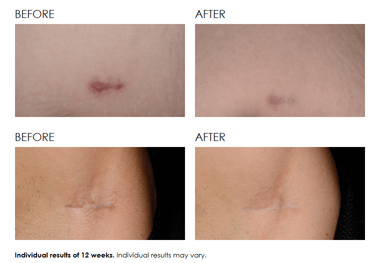 SkinCeuticals Advanced Scar Control New Product Dermacare