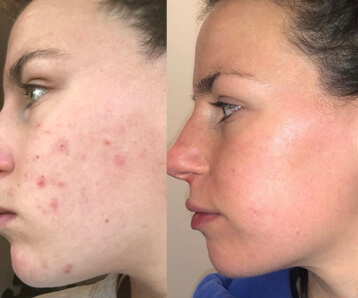 What I Wish I Knew Earlier- My Acne Journey