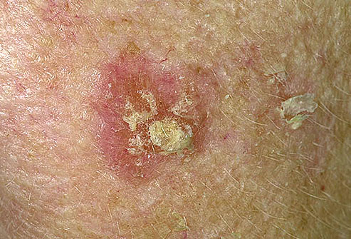 actinic keratosis