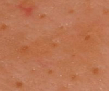 Enlarged Pores 