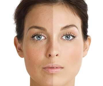 From Causes To Cures, What You Need To Know About Tackling Pigmentation