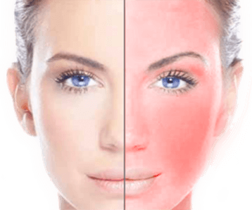 About Rosacea