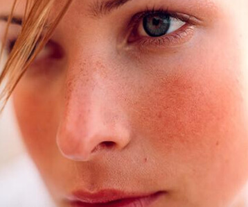 Tips for Treating Rosacea