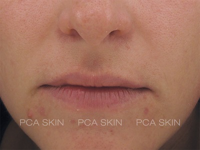 PCA SKIN ACNE GEL BEFORE AND AFTER