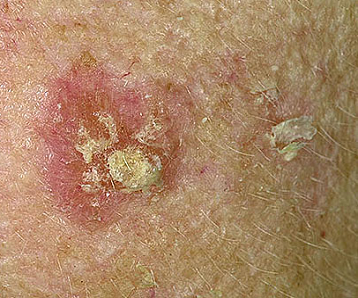 What are Actinic Keratosis or Solar Keratosis skin conditions? 
