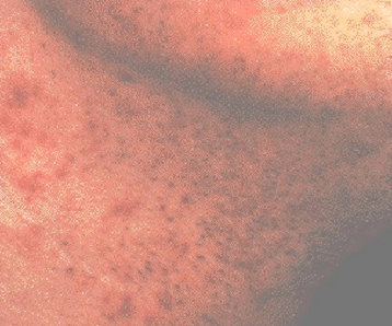 What is Folliculitis?