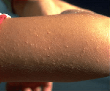 How to manage Keratosis pilaris 