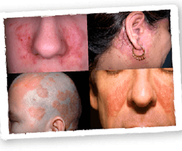How To Treat Seborrheic Dermatitis