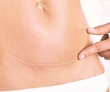 Silicone Scar Treatments for C-section Scars