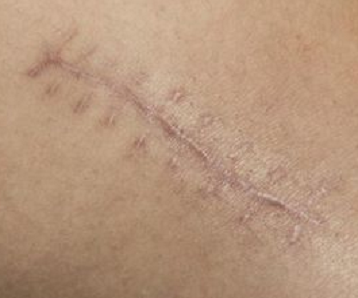 How to prevent and minimise scars?