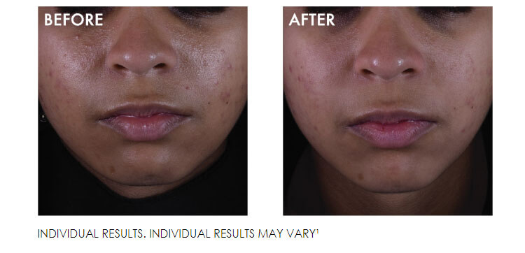 SilyMarin CF Results