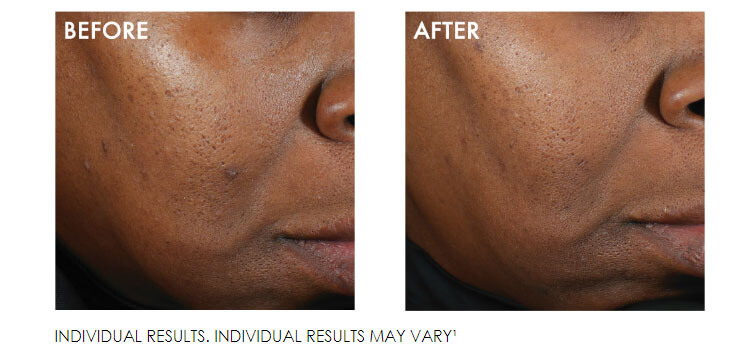 Before and afters SilyMarin CF