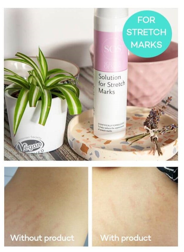 Solution for stretch marks