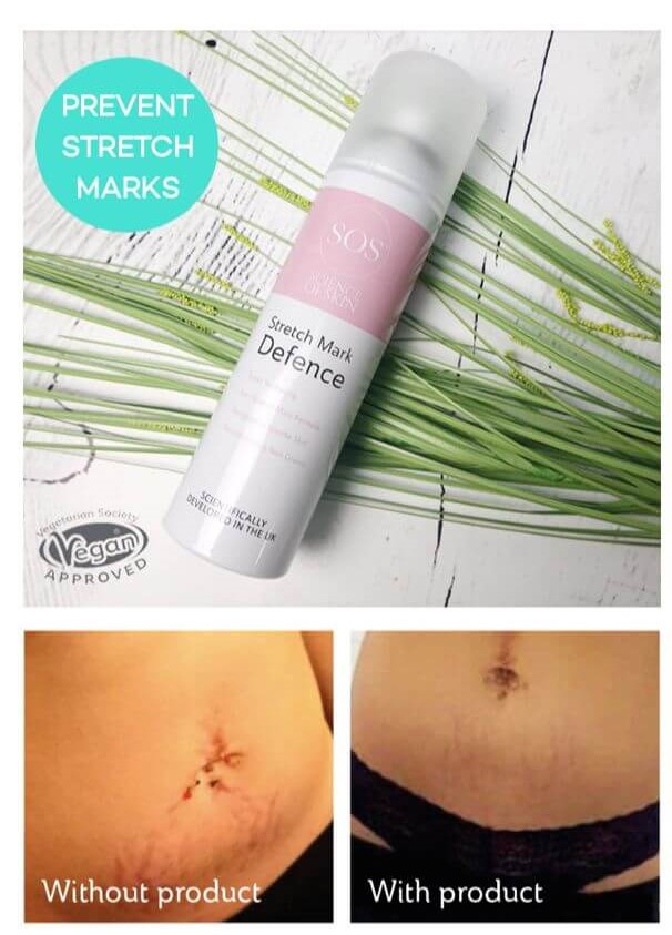 Stretch Mark Defence