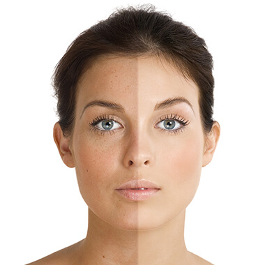 Pigmentation