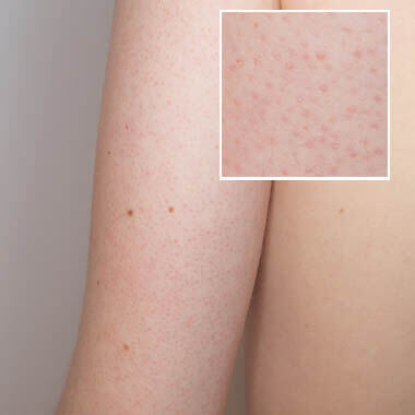 KERATOSIS PILARIS