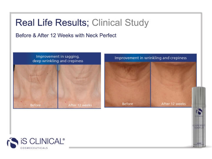 Clinical Study of Neck Perfect Complex before and after photos 