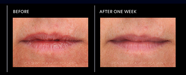 pca lip mask before after