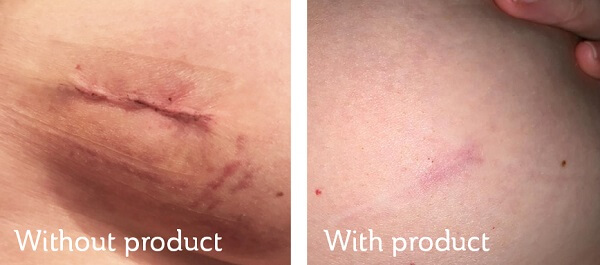 SOS Scar before and after