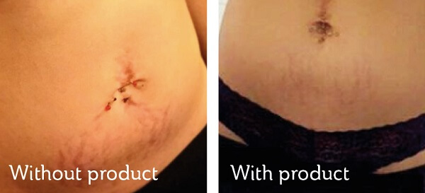 SOS STRETCH MARK BEFORE & AFTER